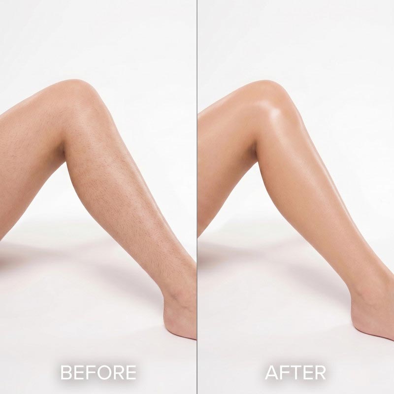 Înainte și după epilare definitivă Craiova 1